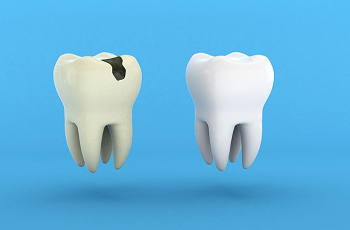 علت پوسیدگی دندان چیست؟